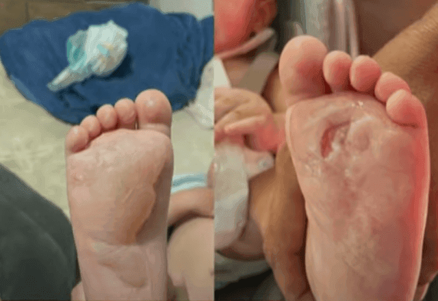 Bebê queima os dois pés em creche no interior de São Paulo