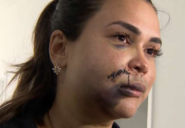 Imagem da noticia SP: Jovem é agredida dentro de restaurante e fica com o rosto desfigurado