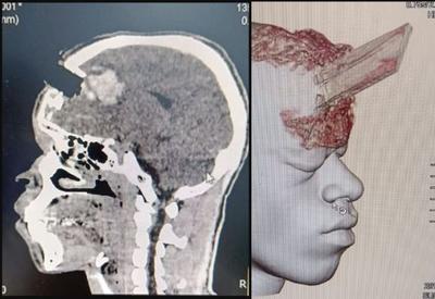Estaca de madeira perfura cabeça de homem; cirurgia de retirada é considerada um sucesso Estaca de madeira perfura cabeça de homem; cirurgia de retirada é considerada um sucesso