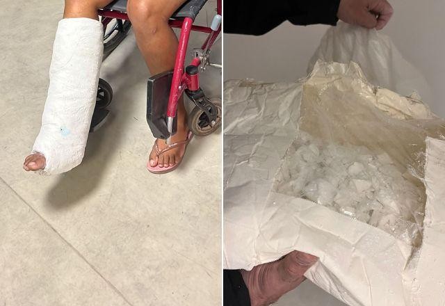 Imagem da noticia Mulher é presa com 3kg de cocaína escondida em gesso na perna