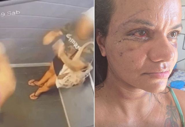 Imagem da noticia Mulher agredida com 60 socos divulga foto do rosto após cirurgia de reconstrução