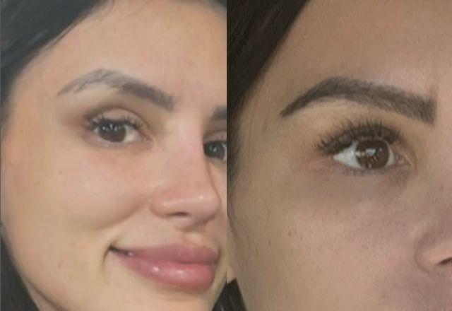 Transplante de sobrancelha: como funciona procedimento feito por Gabriela Cabrini? Transplante de sobrancelha: como funciona procedimento feito por Gabriela Cabrini?