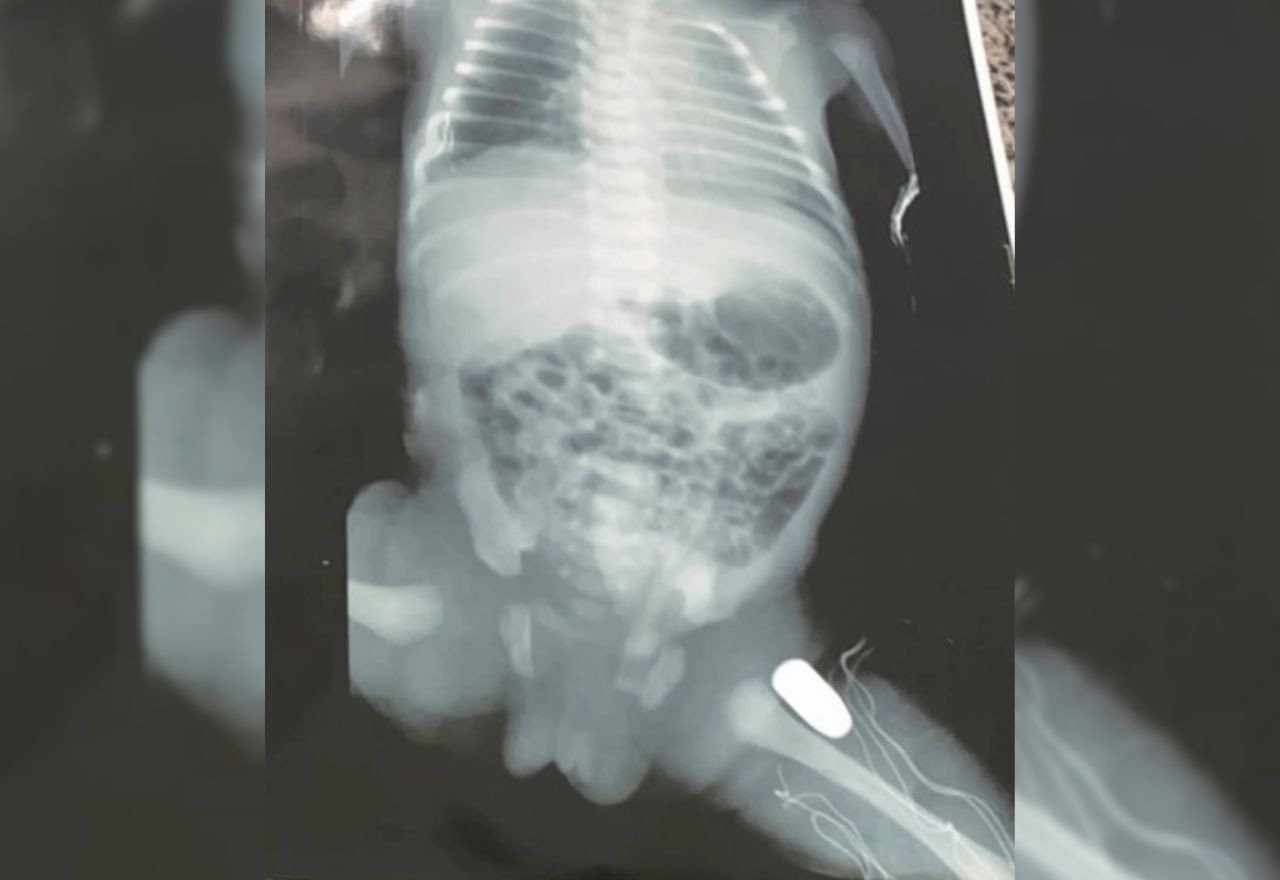 Imagem da noticia Adolescente grávida é atingida por tiro e bala fica alojada na perna do bebê