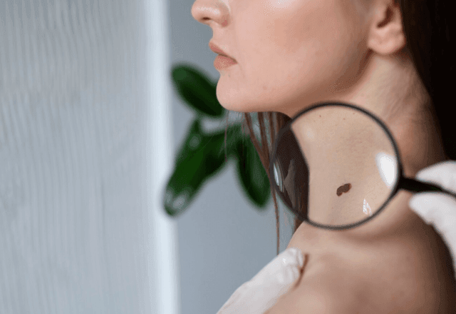 Imagem da noticia Câncer de pele: 8 em cada 10 casos de melanoma são causados pelos raios UV, alerta OMS
