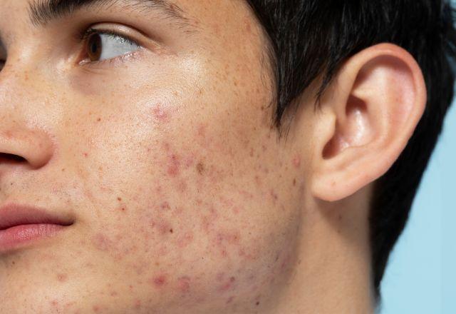 Acne: pesquisadores desenvolvem tratamento que modifica bactéria que causa espinhas Acne: pesquisadores desenvolvem tratamento que modifica bactéria que causa espinhas